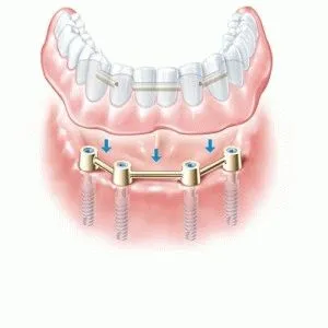 All-on-4 tehnologia protetică dentară 