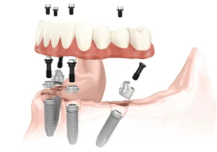 All-on-4 tehnologia protetică dentară 