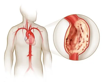 A hasi aorta aneurizma műtét, aorta aneurizma kezelési költségek Moszkvában