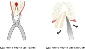 Ненормално вадене на зъб! медицински център Кравченко