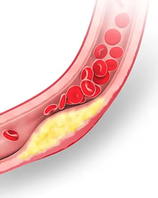 Pathogenesis atherosclerosis megelőző kezelésben - kezelés a szív