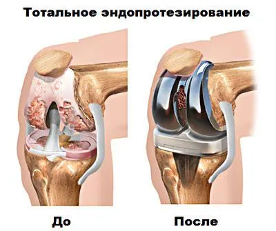 Osteoartrita a articulațiilor cauze, etape și tratamente