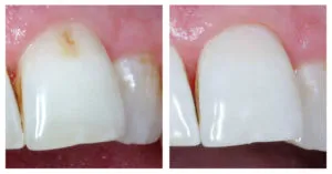Fáj-e vagy sem lő tiszta eltávolítani fogkő a fogak eltávolítása ultrahangos tisztítás