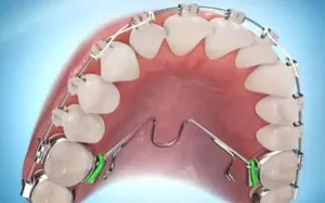 Nadrágtartók és implantátumok