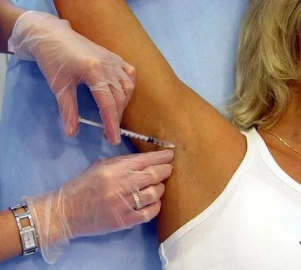 Botox a hónaljban szeszély vagy szükségszerűség