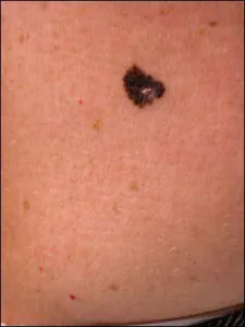 Mi a teendő, ha a vakond fekete, negatív tényezők a melanoma anyajegyet