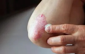 Psoriasis, mint a betegségek kezelésére