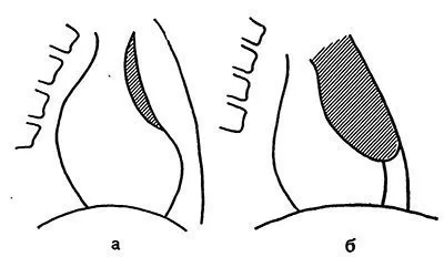 Betegségek diagnosztizálására thymus (csecsemőmirigy) mirigy