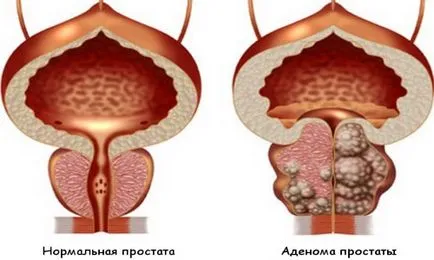 Дифузни промени в простатната жлеза (простатата), какво е това, дешифриране ултразвук