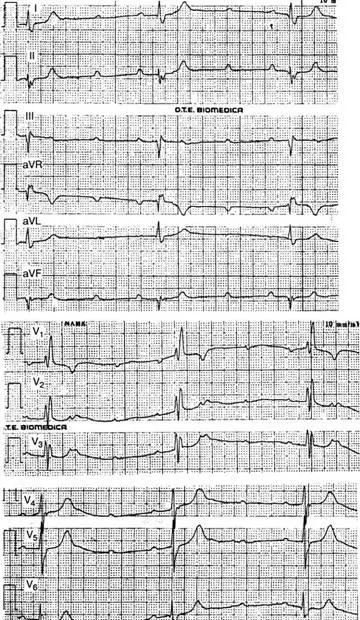 aritmii Criterii electrocardiografice - diagnosticul și tratamentul tulburărilor de ritm cardiac