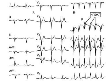 aritmii Criterii electrocardiografice - diagnosticul și tratamentul tulburărilor de ritm cardiac