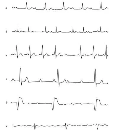 aritmii Criterii electrocardiografice - diagnosticul și tratamentul tulburărilor de ritm cardiac