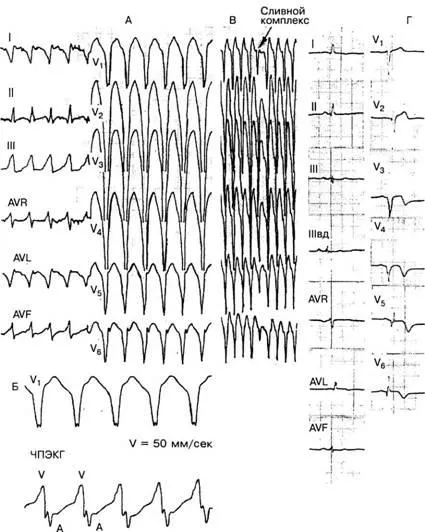 aritmii Criterii electrocardiografice - diagnosticul și tratamentul tulburărilor de ritm cardiac