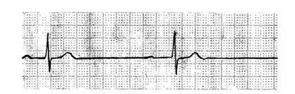 aritmii Criterii electrocardiografice - diagnosticul și tratamentul tulburărilor de ritm cardiac