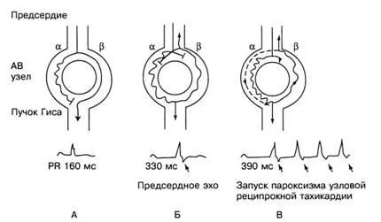 aritmii Criterii electrocardiografice - diagnosticul și tratamentul tulburărilor de ritm cardiac