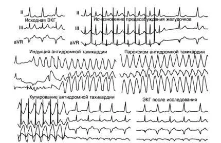 aritmii Criterii electrocardiografice - diagnosticul și tratamentul tulburărilor de ritm cardiac