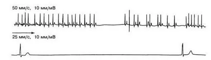 aritmii Criterii electrocardiografice - diagnosticul și tratamentul tulburărilor de ritm cardiac