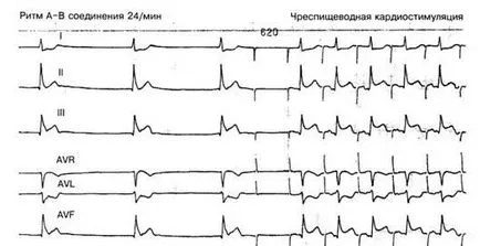 aritmii Criterii electrocardiografice - diagnosticul și tratamentul tulburărilor de ritm cardiac