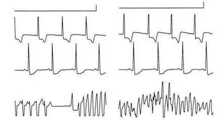 aritmii Criterii electrocardiografice - diagnosticul și tratamentul tulburărilor de ritm cardiac