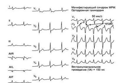 aritmii Criterii electrocardiografice - diagnosticul și tratamentul tulburărilor de ritm cardiac