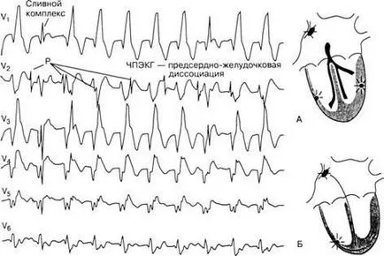 aritmii Criterii electrocardiografice - diagnosticul și tratamentul tulburărilor de ritm cardiac