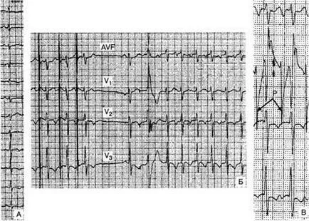 Електрокардиографските критерии аритмии - диагностика и лечение на нарушения на сърдечния ритъм
