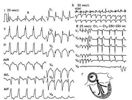 Електрокардиографските критерии аритмии - диагностика и лечение на нарушения на сърдечния ритъм