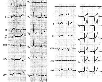 aritmii Criterii electrocardiografice - diagnosticul și tratamentul tulburărilor de ritm cardiac