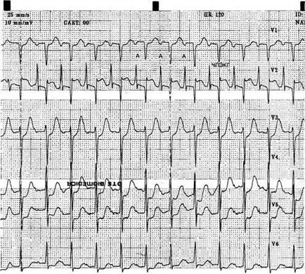 aritmii Criterii electrocardiografice - diagnosticul și tratamentul tulburărilor de ritm cardiac