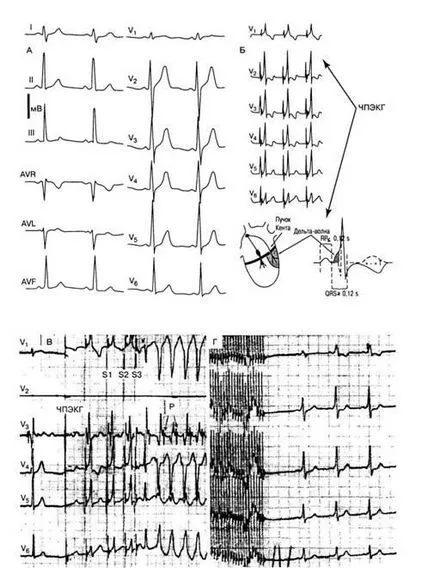 aritmii Criterii electrocardiografice - diagnosticul și tratamentul tulburărilor de ritm cardiac