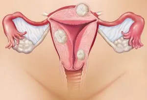 uterin fibromatoza ce este, simptome, tratament