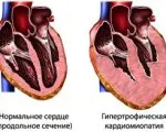 Az alultápláltság szív - okai, tünetei és kezelése