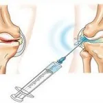 A hialuronsav az ízületek felülvizsgálati készítmények injekciók céljára a térd