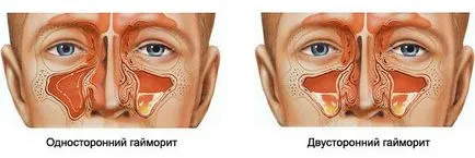 Синузит в симптоми и лечение на деца на детето