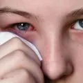 Кератитът капки за очи, когато един мъж, за очното заболяване