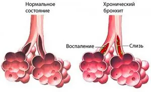 Гноен фарингит, отколкото и как да се отнасяме