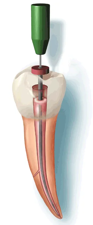 Hot gutapercă, clinica - Le Dent