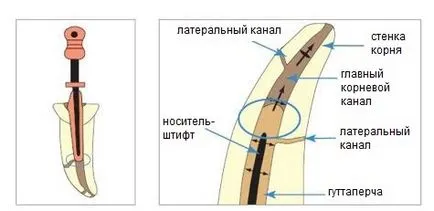 Hot gutapercă, clinica - Le Dent