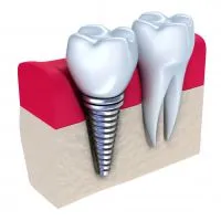 Implanturile dentare - contraindicații și posibile complicații