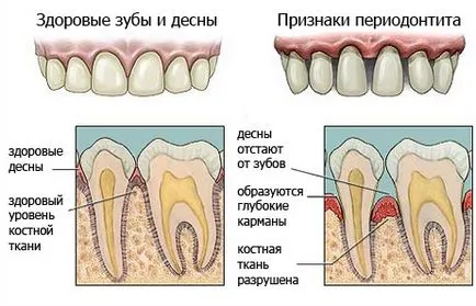 Fertőző periodontitis - fogászat enciklopédia