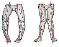 Curbura partea inferioară a piciorului - cauze, simptome, diagnostic și tratament