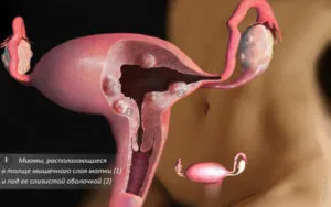 uterin intramural fibroame simptome, tratament