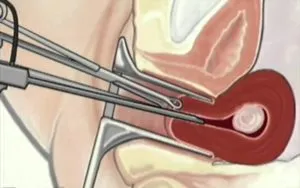 uterin intramural fibroame simptome, tratament