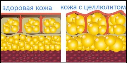 Как да се отървете от целулита част 1 от проблема - fitnesomaniya за всички!