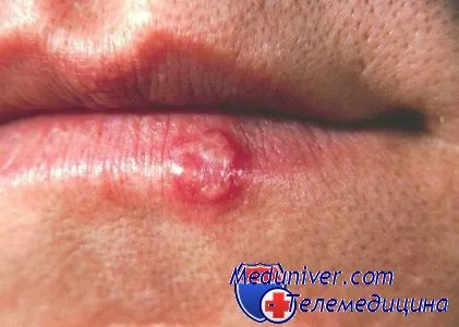 Hogyan kell kezelni a herpes ajakherpesz tüneteket okoz