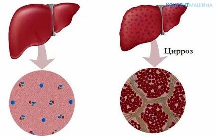 Hogyan kell kezelni cirrhosis népi jogorvoslati