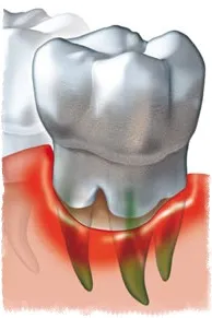 Как да изплакнете устата с хлорхексидин по време на гингивит, всички на зъбите