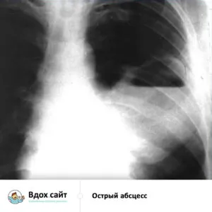 Lung tratament abces, simptome, raze X și semne radiologice, chirurgie operatorie