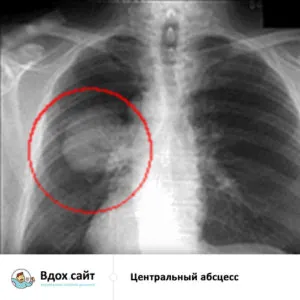 Lung tratament abces, simptome, raze X și semne radiologice, chirurgie operatorie