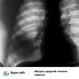 Lung tratament abces, simptome, raze X și semne radiologice, chirurgie operatorie